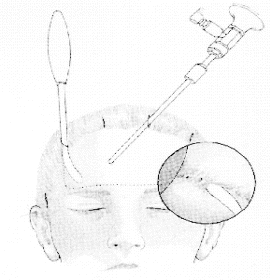 Endoscopic brow lift — step 4