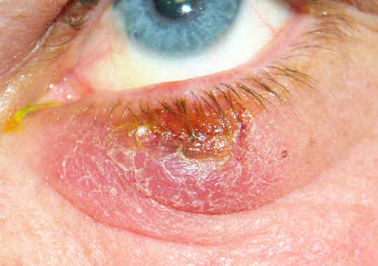 Chalazion clinical appearance
