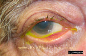 Ectropion — outward turning of the lower eyelid