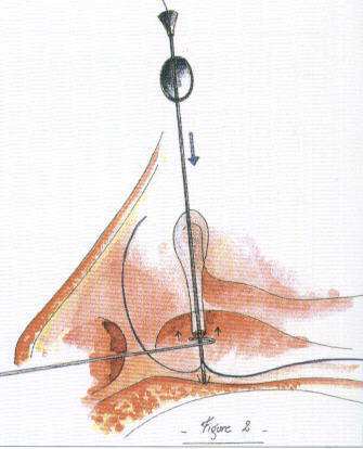 Layered eyelid laceration repair